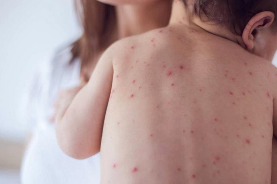 Una mujer antivacunas le contagió el sarampión a sus cinco hijos | Noticias