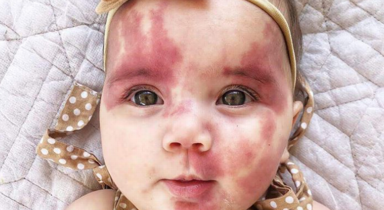 La lección viral de una madre a los que llamaron "fea" a su hija por tener marcas de nacimiento | Redes