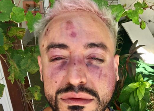 Brutal ataque homofóbico de una patota a un joven diseñador | Información General