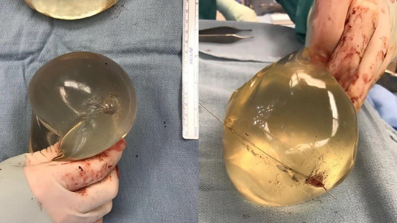 Le dispararon y salvó su vida por los implantes de siliconas que tenía en los pechos | Redes