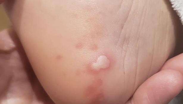 Estudio: las cinco manifestaciones del coronavirus en la piel de los enfermos | Información General