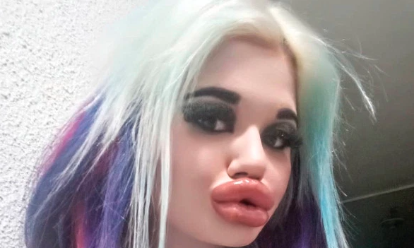 La joven que se dio 20 inyecciones para tener los labios más grandes del mundo | Redes