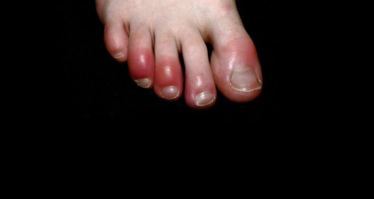 "Dedos coronavirus": el doloroso síntoma de covid-19 que advierten los dermatólogos | Información General