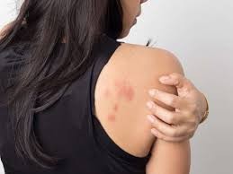 Un estudio afirma que las erupciones en la piel debe ser considerado como un síntoma de coronavirus | Información General