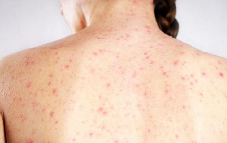 Argentina dio por terminado el brote de sarampión y lo informó a la OMS | Nacionales