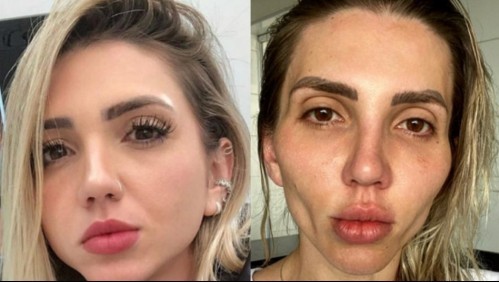 El drama de la tiktoker que se operó la cara: "Me convertí en una calavera" | Redes