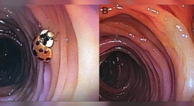 Descubrieron que un hombre tenía a una vaquita de San Antonio viviendo en el intestino | Redes