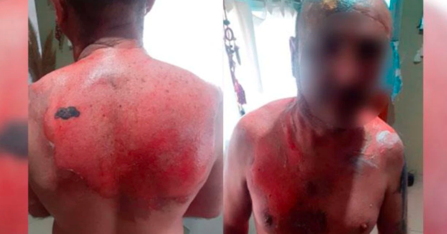 Un hombre fue atacado por su expareja con agua hirviendo | Nacionales