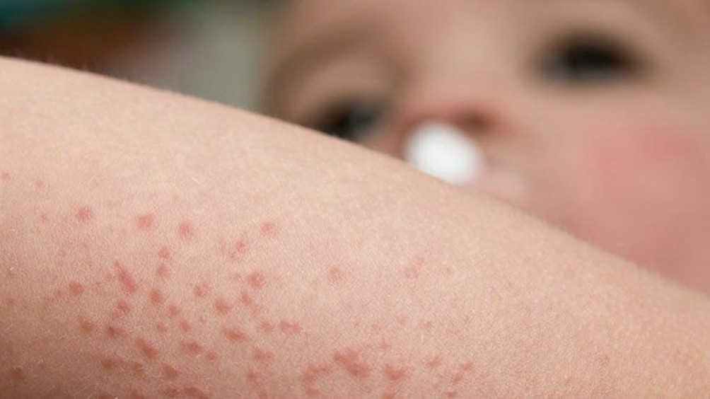 Dermatitis Atópica, un trastorno cutáneo que padecen entre un 15 y 30% de niños y niñas | Información General