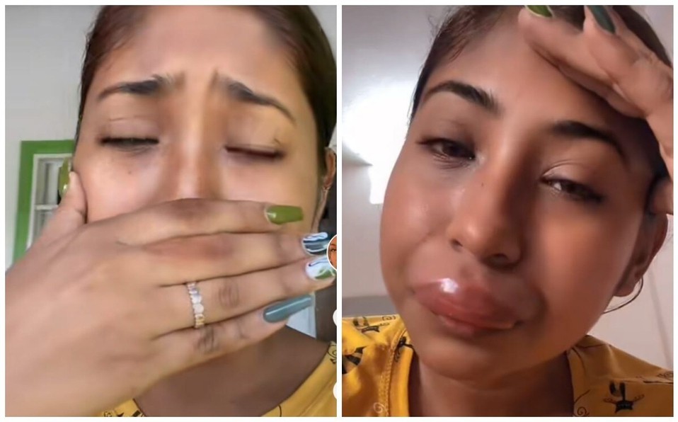 Video: una chica se volvió viral al mostrar cómo le quedaron los labios tras la picadura de una abeja | Redes