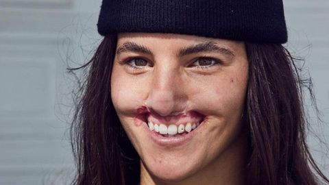 Una modelo se operó para recuperar el labio que perdió al ser atacada por un perro | Espectaculos