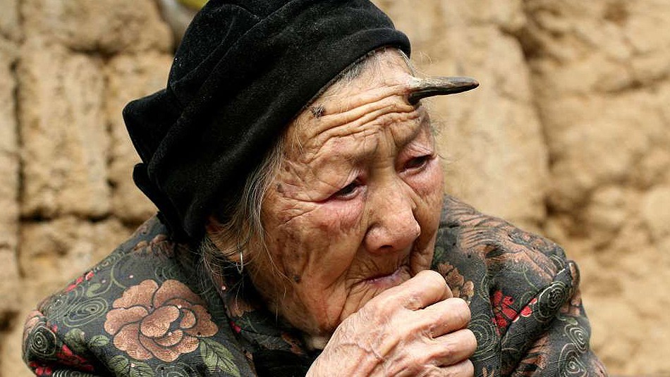 La historia de la mujer de 101 años a la que le salió un cuerno en la frente | Redes
