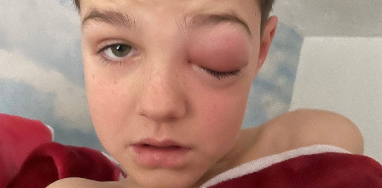 "Ojo covid": un nene de 9 años casi pierde la visión tras contagiarse coronavirus | Internacionales