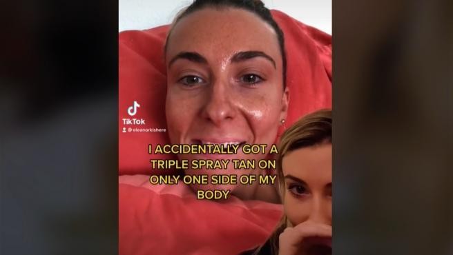 Así quedó una mujer tras una sobredosis de spray de bronceado | Información General