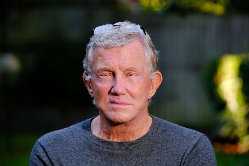 Un hombre lleva tres años sin poder cerrar los ojos tras cirugía plástica fallida | Información General