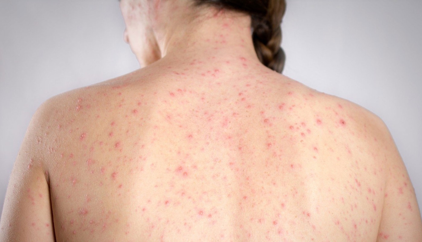 Alerta epidemiológico: El Ministerio de Salud informó un "posible caso" de sarampión en CABA | Nacionales