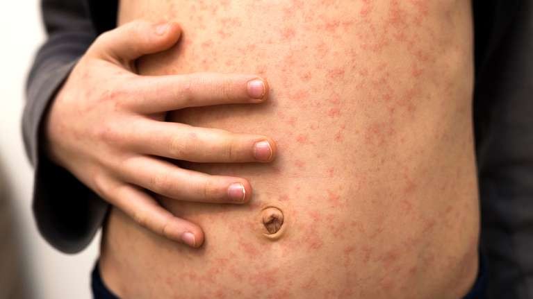 Sarampión: cómo se contagia, quiénes deben vacunarse y quiénes no | Noticias