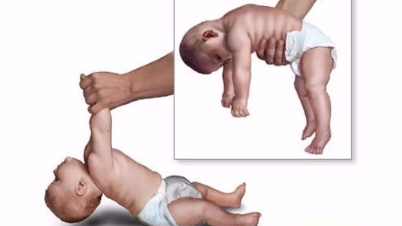 Qué es la enfermedad de Pompe: tiene tratamiento pero es fundamental el diagnóstico temprano | Información General