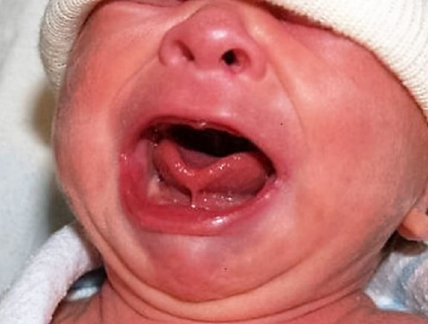 La moda de cortar el frenillo de la lengua de los bebés para favorecer la lactancia | Información General