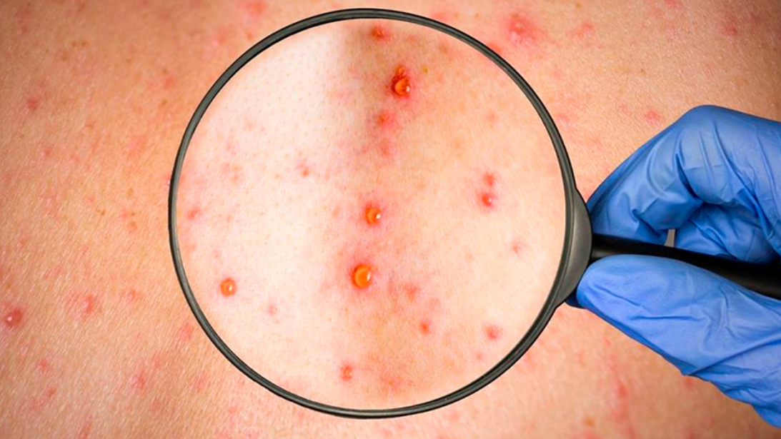 Tiene "alta compatibilidad" con viruela de mono el caso detectado en Argentina | Noticias