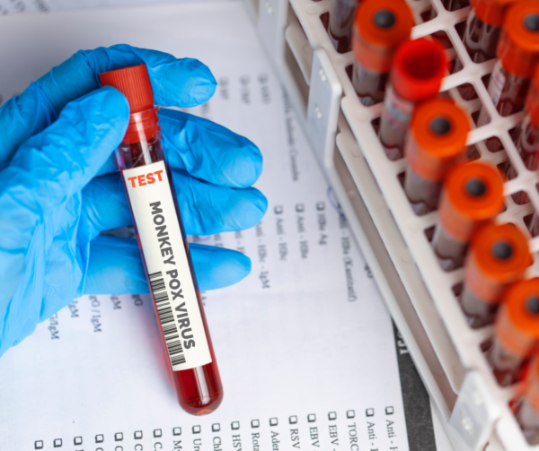Dos nuevos casos de viruela del mono en Argentina | Nacionales