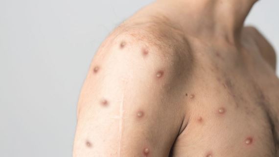 Viruela del mono: ya hay 24 casos confirmados en el país | Nacionales