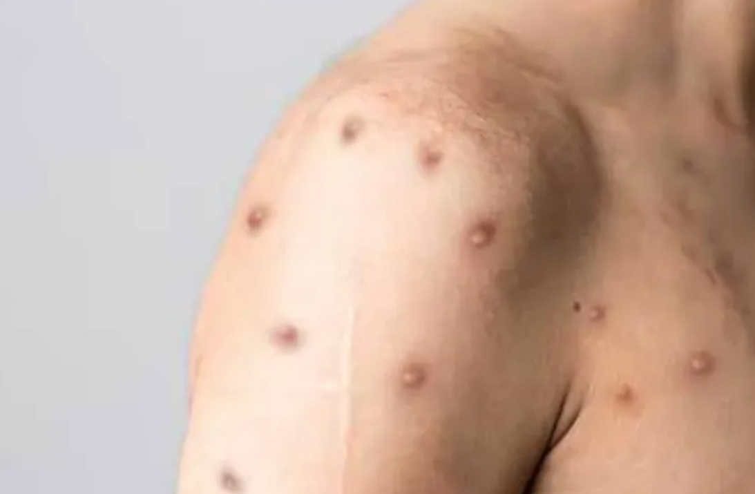 Dos nuevos casos sospechosos de viruela del mono en Rosario | Noticias