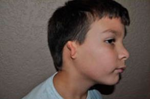 Investigan casos de microtia, una malformación congénita en la oreja que puede causar hipoacusia | Información General