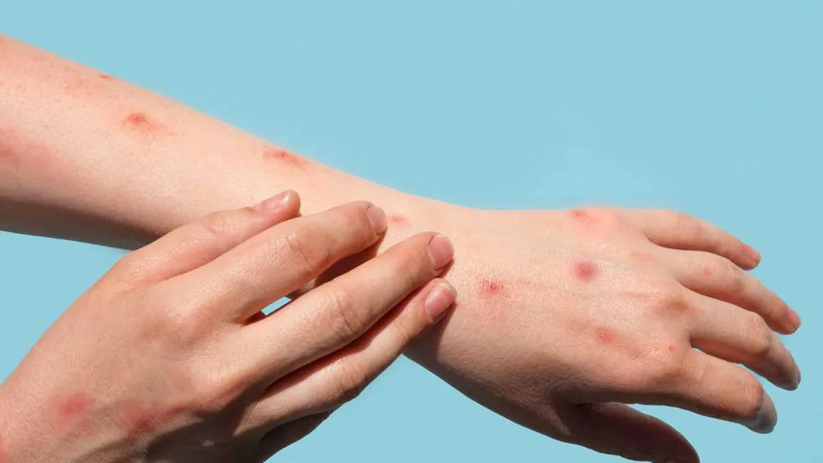 El Ministerio de Salud informó que se registró el tercer caso de Viruela Símica en Santa Fe | Noticias