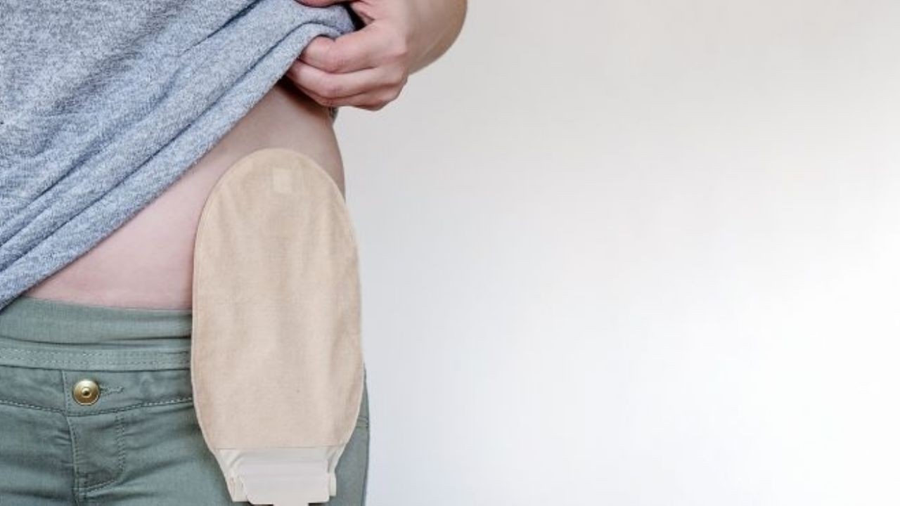 Once provincias adhirieron a la ley que da cobertura a personas ostomizadas | Información General