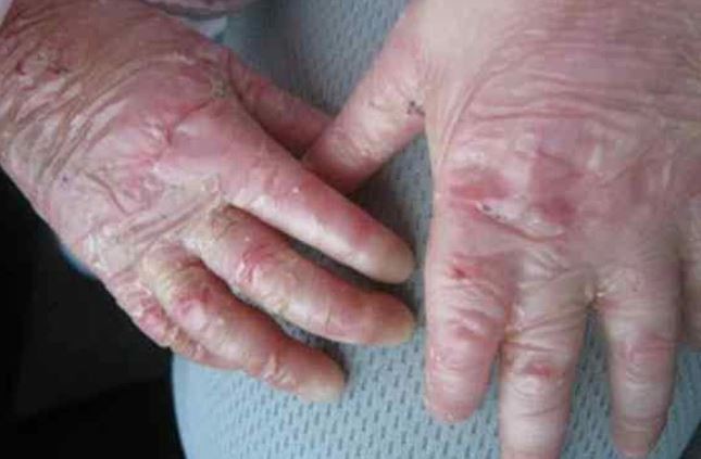 Bebés que nacen con ampollas pueden tener “Piel de Cristal” | Nacionales