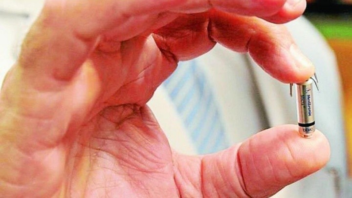 El Hospital Posadas realizó el primer implante de marcapasos sin cable en el país | Nacionales