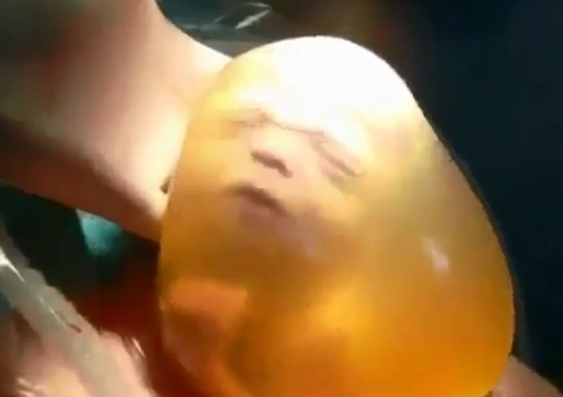 Parto velado en Rosario: ocurre uno cada 80 mil nacimientos | Salud