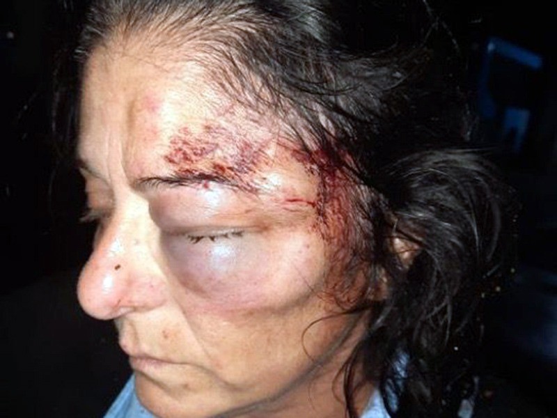 Rosario: desfiguraron a colectivera con brutal golpiza durante un robo | Noticias