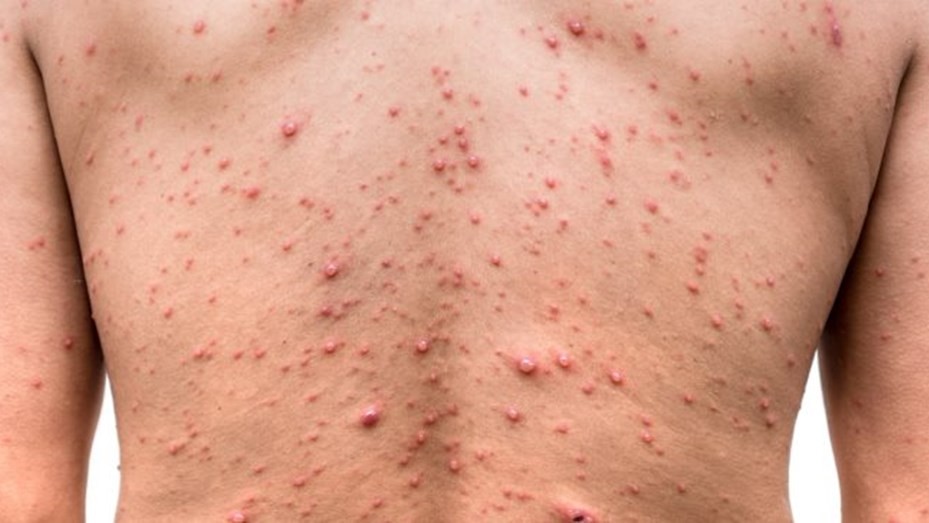 La OMS aseguró que la viruela del mono ya no es una emergencia sanitaria global | Noticias