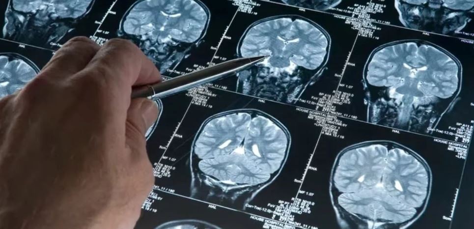 Científicos de la UBA investigan cómo detectar el alzheimer con inteligencia artificial | Salud