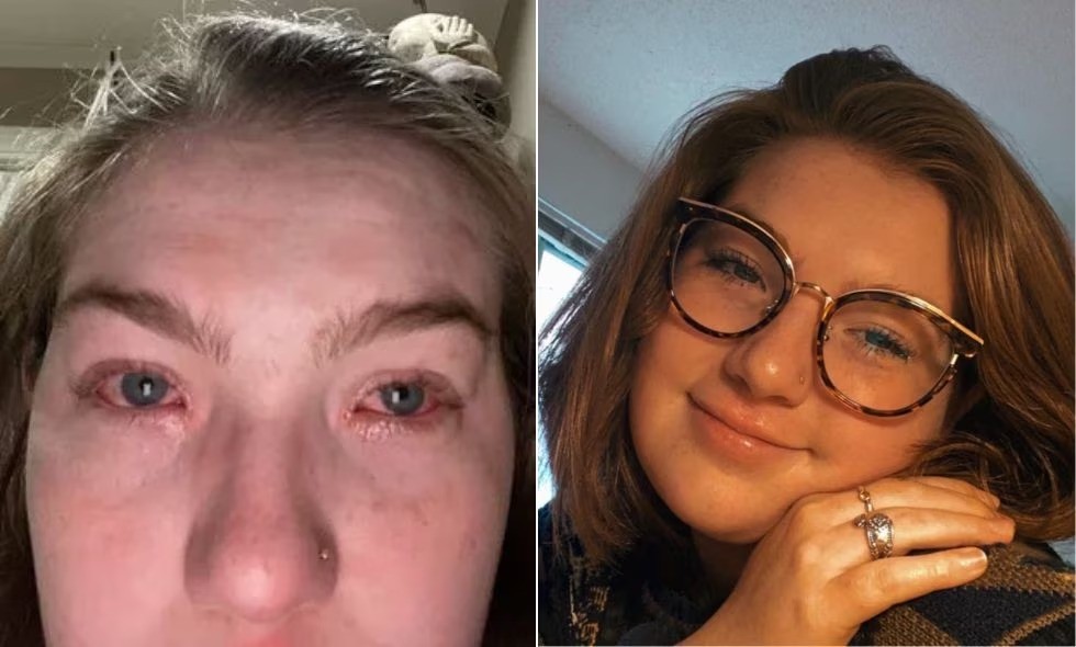 Insólito: una joven descubrió que es alérgica a su novio y explotaron las redes | Redes