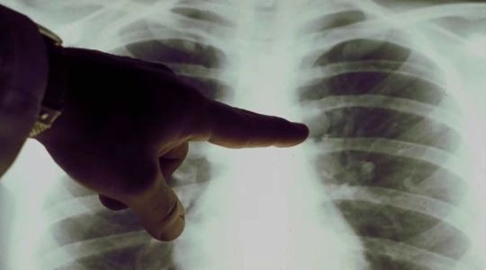 Presentan en la Argentina un nuevo tratamiento para un tipo de cáncer de pulmón | Salud