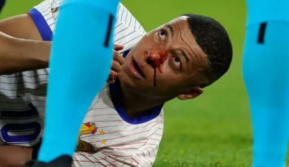 Mbappé se fracturó la nariz: será operado y podría perderse el resto de la Eurocopa | Deportes