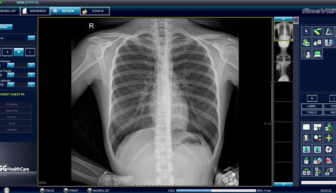 El gobierno licitó la compra de 40 digitalizadores de placas radiográficas | Salud