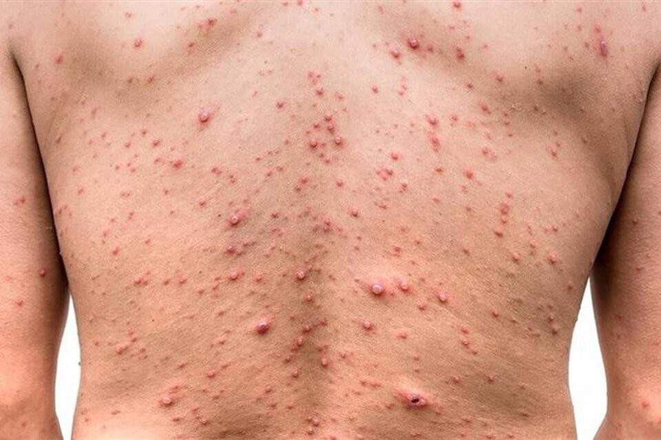 Viruela del mono: el caso santafesino es una mujer que no tiene antecedentes de viaje | Salud