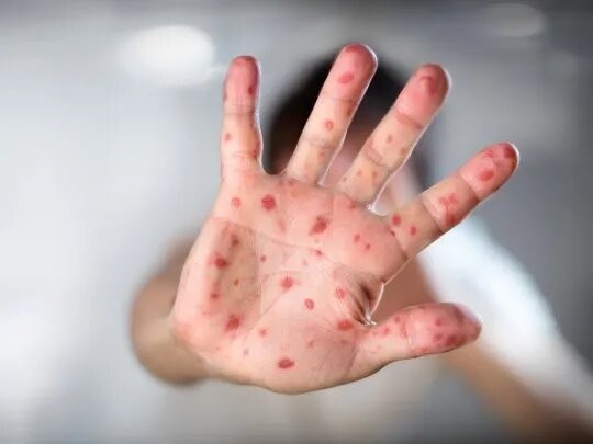 Alerta por Viruela del mono en Argentina: confirman el sexto caso | Salud