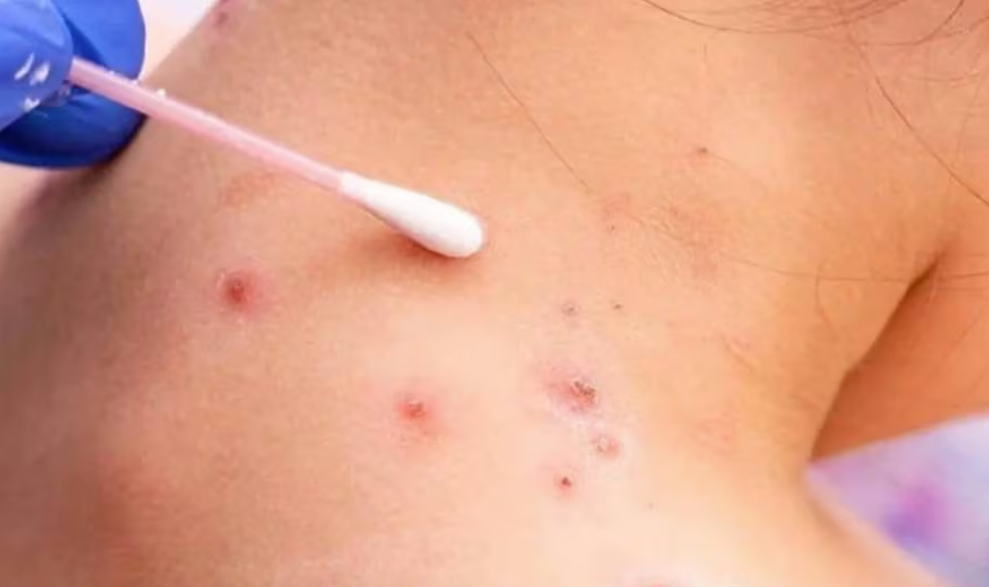 Se detectaron más de 20 casos de viruela del mono en Argentina | Salud