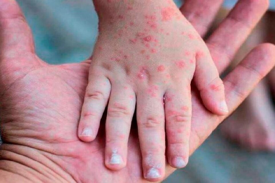 Avanza la viruela del mono en Argentina: reportaron 10 casos nuevos | Salud