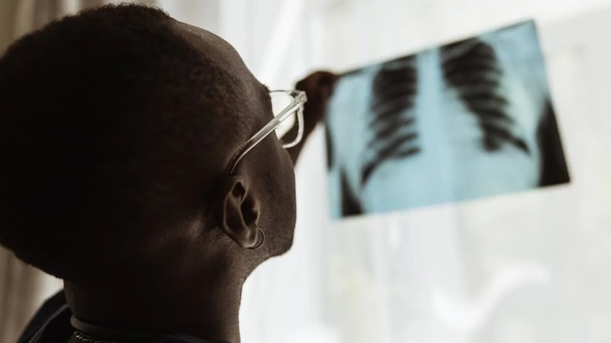 Los casos de tuberculosis aumentaron un 38% en Argentina | Salud