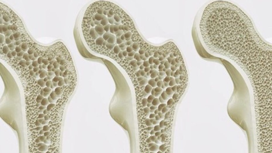 Día Mundial de la Osteoporosis: una de cada tres mujeres mayores de 50 años sufrirá una fractura por osteoporosis | Salud