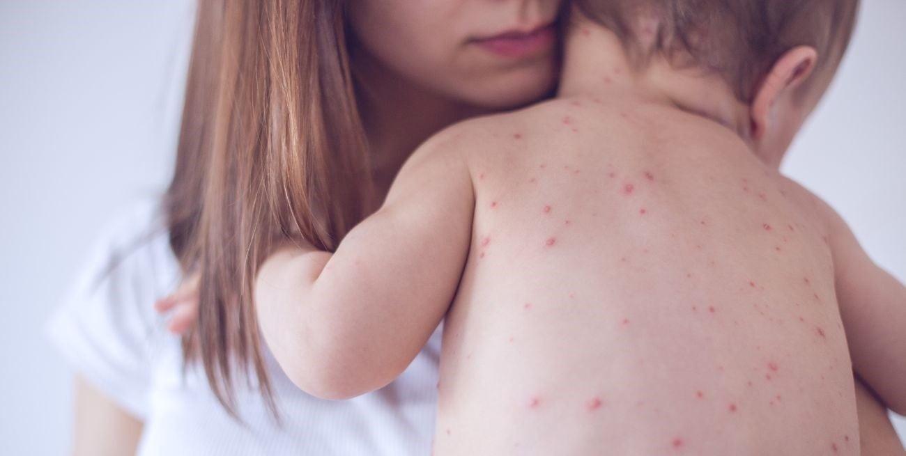 Sarampión: El Ministerio de Salud emitió alerta epidemiológica | Salud