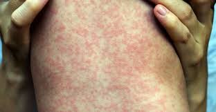 Sarampión: el menor de Entre Ríos evoluciona en condiciones favorables | Salud