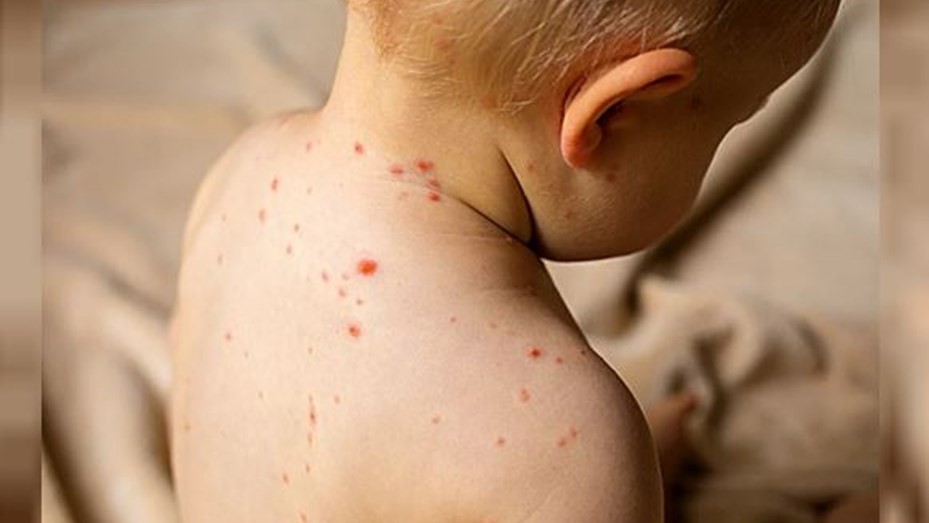 Alerta epidemiológica por nuevos casos de sarampión | Salud