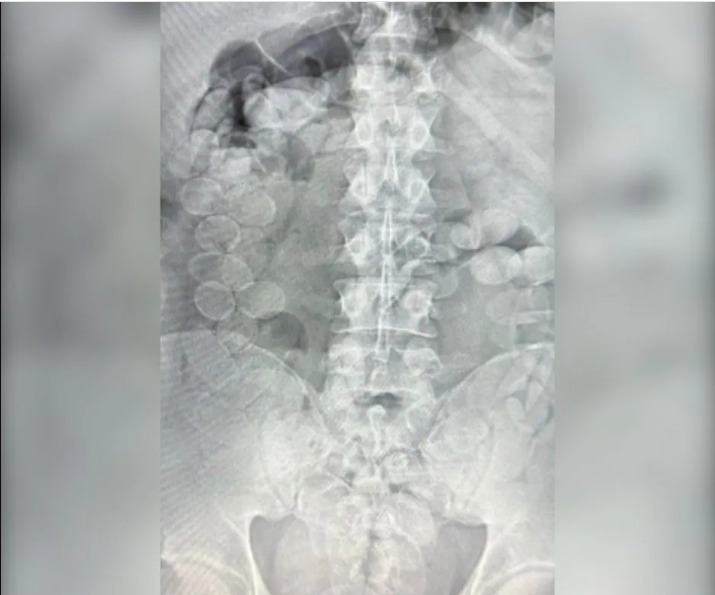 Condenan a dos hombres por transportar cocaína ingerida en cápsulas en Santa Fe | Información General